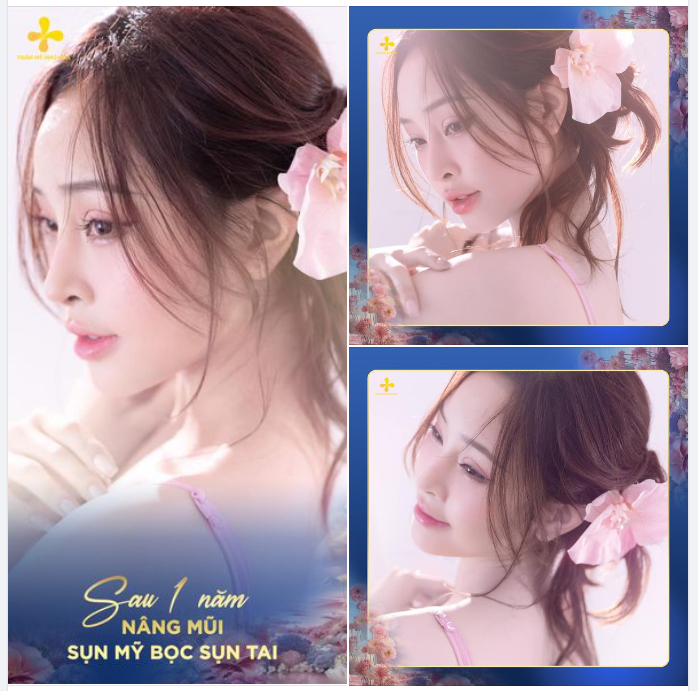 Kỷ niệm một năm sửa lại dáng mũi của bạn Phạm Hoàng Phúc.