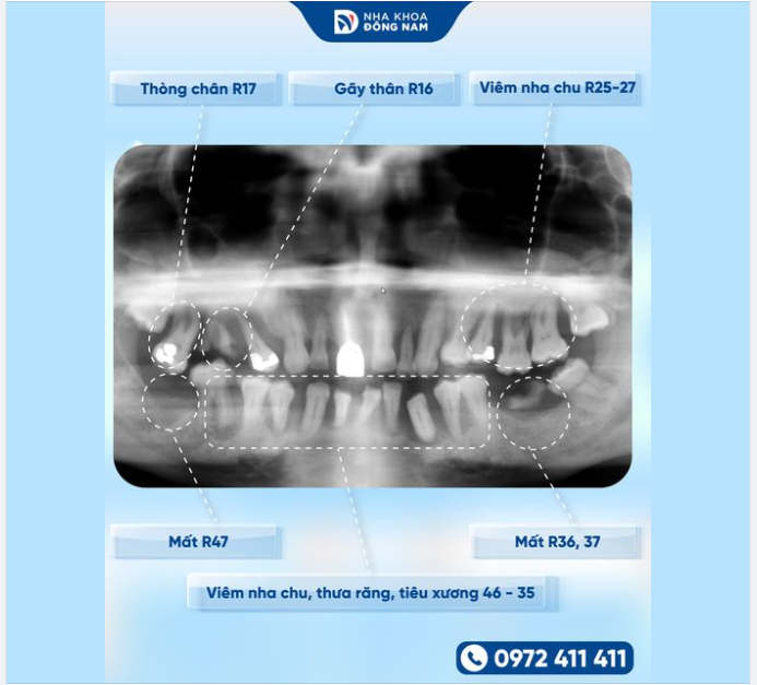 ĐỪNG ĐỂ NỖI NGẠI ĐẾN NHA KHOA “ĐÁNH CẮP” NỤ CƯỜI CỦA BẠN