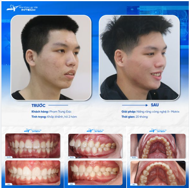 MỘT HÀM RĂNG ĐẸP CÓ THỂ “CHỮA LÀNH” TÂM HỒN NHƯ THẾ NÀO?