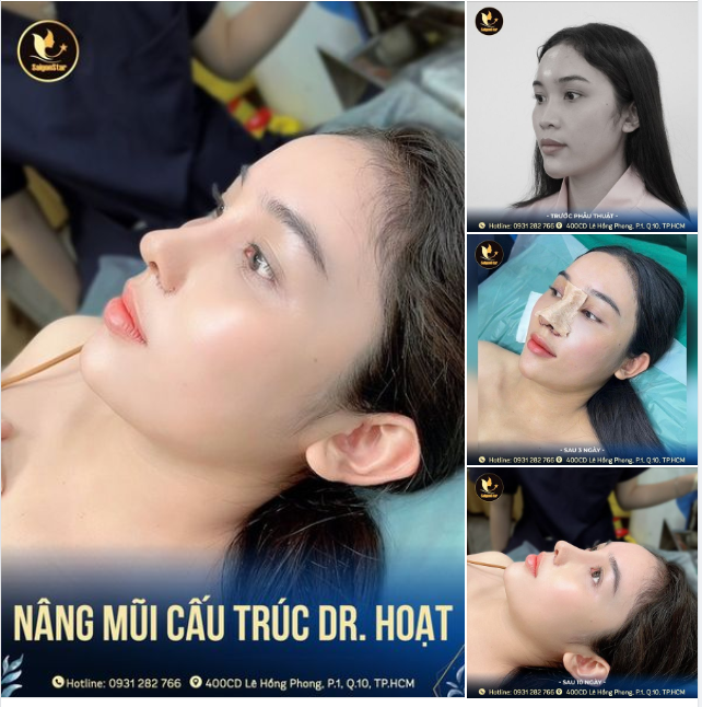 Ca mũi cấu trúc Dr. Hoạt sau 10 ngày thực hiện đây cả nhà ơi!