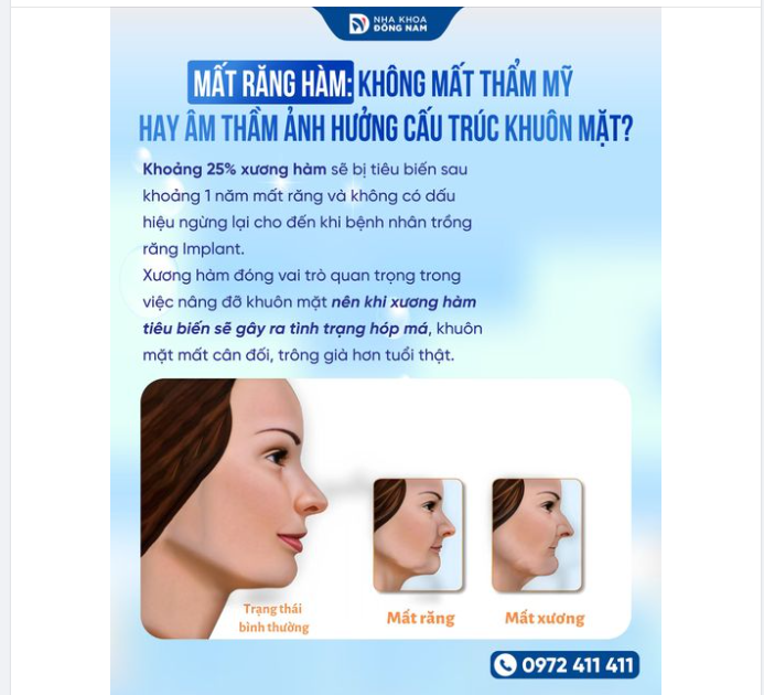 MẤT RĂNG HÀM: LẦM TƯỞNG KHÔNG ẢNH HƯỞNG ĐẾN THẨM MỸ NHƯNG KHIẾN BẠN GIÀ HƠN TUỔI THẬT