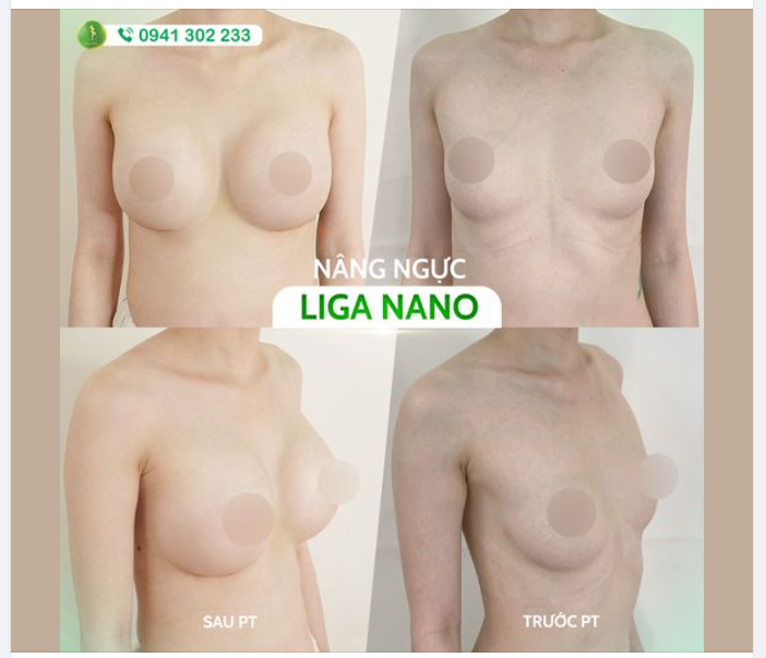 SỤ THẬT VỀ PHƯƠNG PHÁP NÂNG V1 ĐANG ĐƯỢC ƯA CHUỘNG NHẤT HIỆN NAY