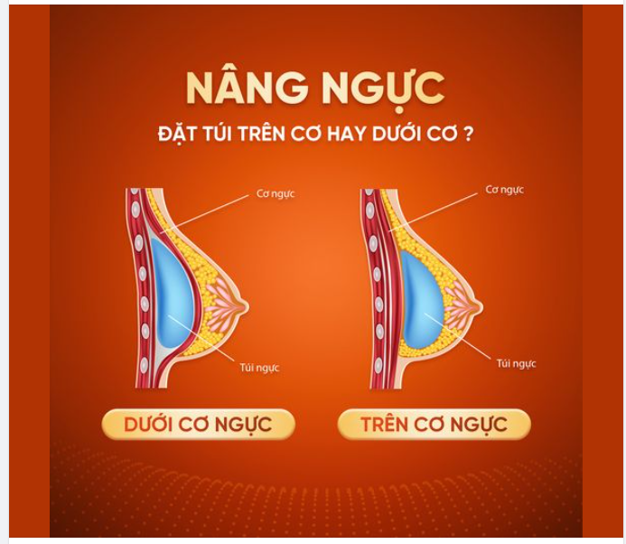 Nâng ngực đặt túi trên hay dưới cơ? Phương pháp nào tốt hơn?