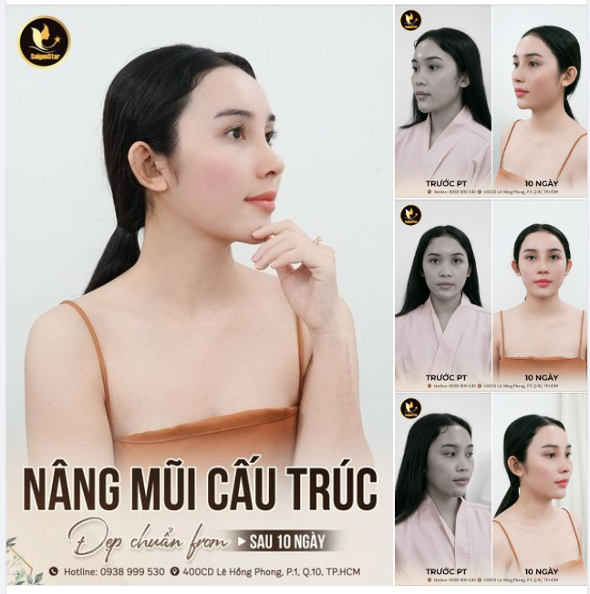Chỉ mất 60 phút thực hiện và 10 ngày hồi phục – Khách hàng Thùy Dương sở hữu ngay góc nghiêng siêu nét, thành công xóa bỏ sự tư ti về dáng mũi thấp tẹt cùng NÂNG MŨI CẤU TRÚC!