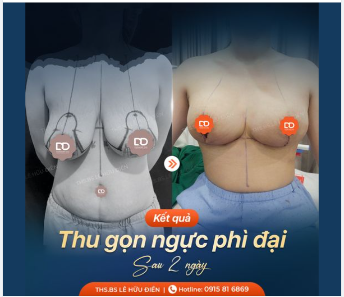 Không chỉ ngực nhỏ mới tự ti. Ngực phì đại cũng khiến chị em mặc cảm, dễ gặp nhiều vấn đề về sức khoẻ, xương khớp.