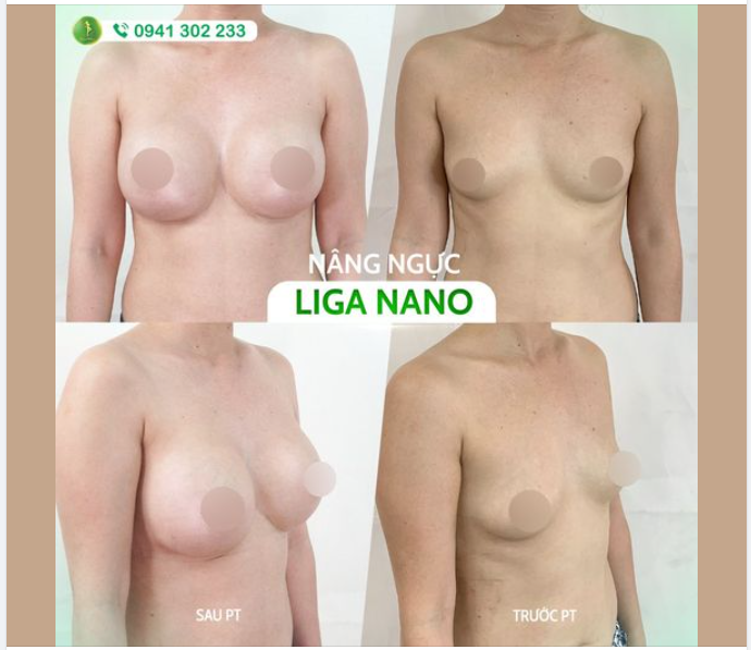 3 ĐẶC ĐIỂM HOÀN HẢO KHI SỞ HỮU V1 LIGA NANO