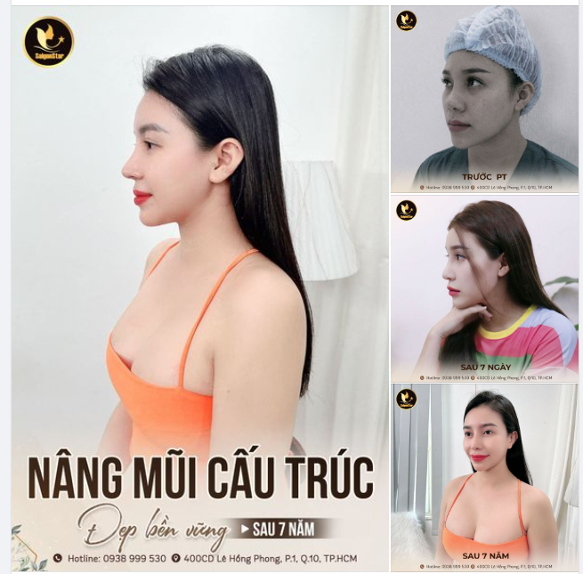 Ai bảo nâng mũi lâu năm không còn đẹp mà dễ gặp biến chứng thì VÀO ĐÂY chiêm ngưỡng ngay DÁNG MŨI CẤU TRÚC SAU 7 NĂM của nhà Dr. Hoạt đây!
