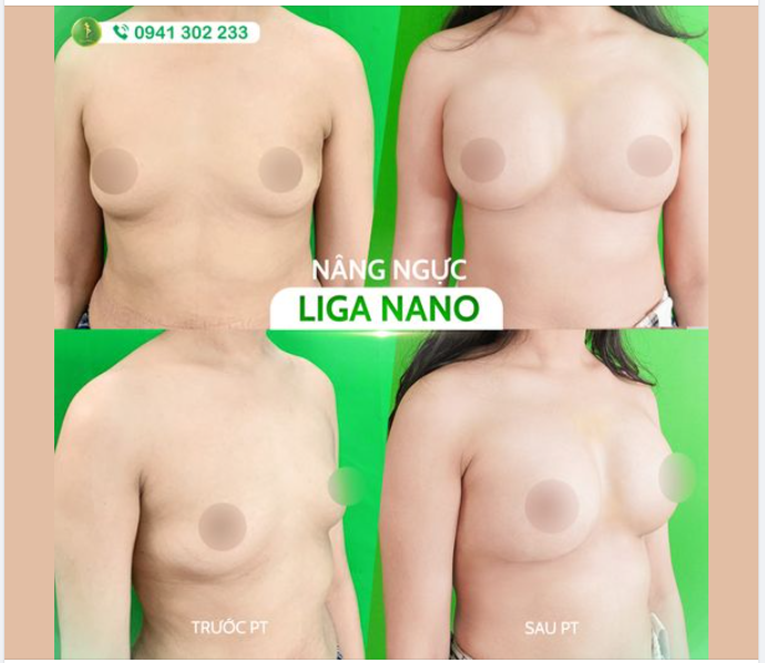 V1 ĐẸP CĂNG TRÀN VỚI NÂNG LIGA NANO TẠI SAIGON VENUS
