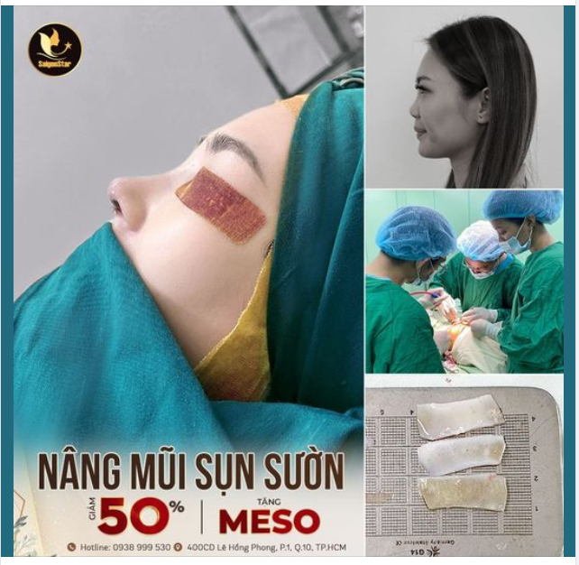 KẾT QUẢ NÂNG MŨI SỤN SƯỜN KH: JASMINE TAN (SINGAPORE)