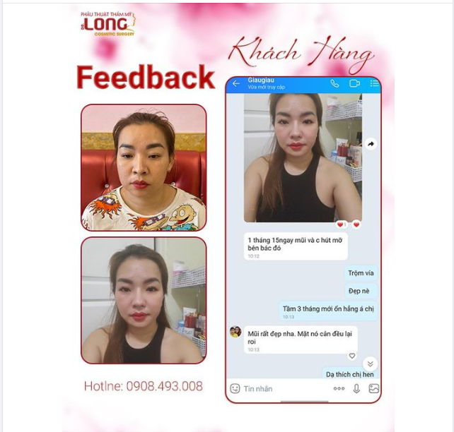 Sự Hài Lòng của Khách Hàng - Phản Hồi Sau 15 Ngày Sử Dụng Dịch Vụ Hút M.ỡ và Nâng Mũi tại PTTM Bác sĩ Long.