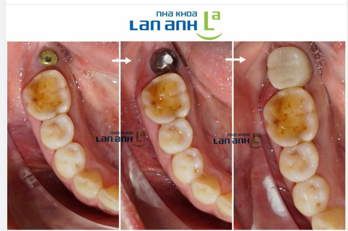 Cấy ghép Implant cho trường hợp mất răng số 7