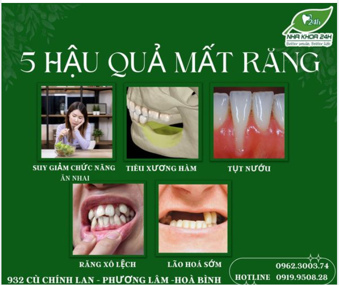 HẬU QUẢ NGUY HIỂM KHI MẤT RĂNG LÂU NGÀY
