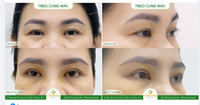 Cung mày bị sụp là một tình trạng khó ưa khiến nhiều người đau đầu. Nó làm cho đôi mắt của mọi người trông lờ đờ, thiếu sức sống.