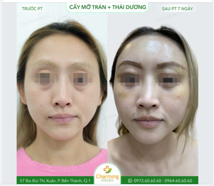 Có nhiều người nghĩ vùng trán và thái dương có ra sao cũng không quan trọng. Tuy nhiên thực chất thì đây chính là 2 vùng đóng vai trò khá lớn trong việc nhìn gương mặt của bạn có trẻ hay không.