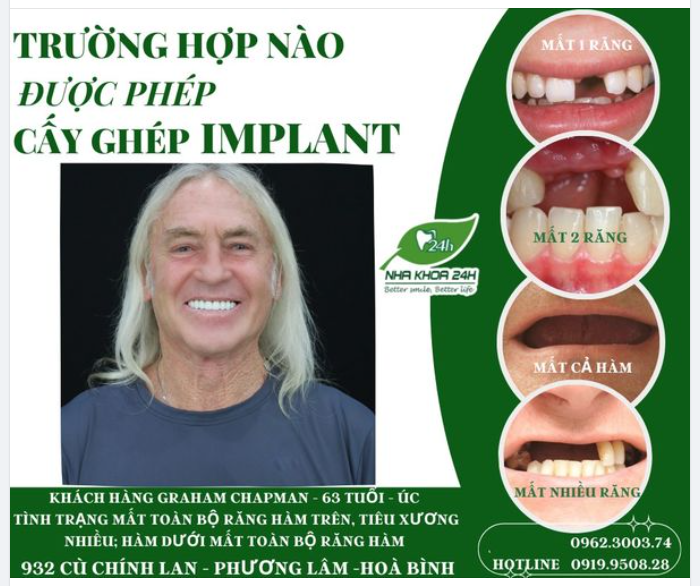 TRƯỜNG HỢP NÀO ĐƯỢC PHÉP CẤY GHÉP IMPLANT