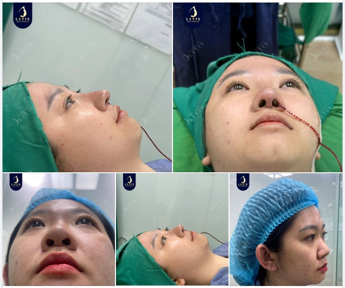 Đầu mũi to, nền xương mũi rộng cùng sóng mũi không quá cao khiến em gái thiếu tự tin khi đứng trước mọi người.