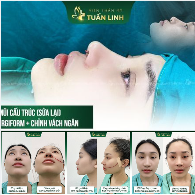 Cùng xem sự thay đổi trước và sau phẫu thuật của bạn ấy ở ngay pic này nha!