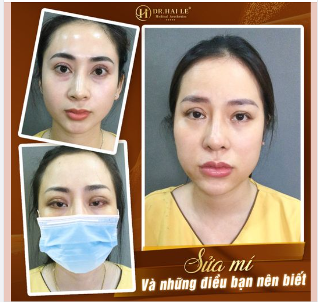 Sửa mí những điều bạn cần biết