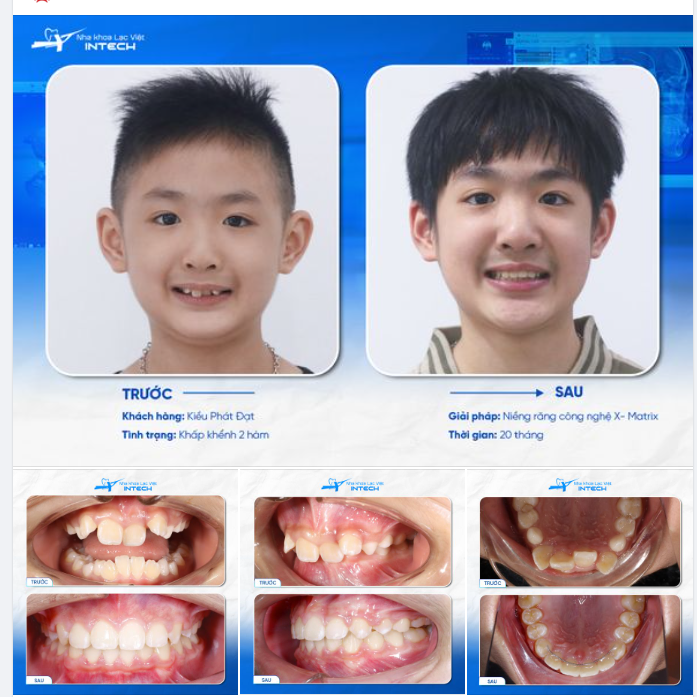 "DẬY THÌ THÀNH CÔNG", THAY ĐỔI TƯƠNG LẠI CHO BÉ NHỜ NIỀNG RĂNG!
