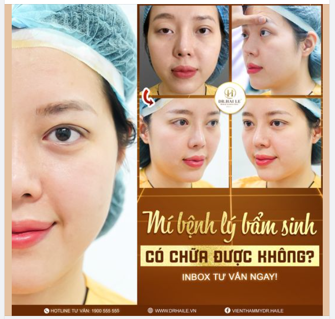Mí bệnh lý bẩm sinh bao gồm các tình trạng như nhược cơ nâng mi gây sụp mí, cường cơ nâng mi gây trợn, lồi mắt, vừa cường cơ vừa nhược cơ…