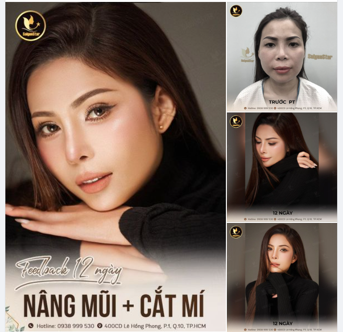 FEEDBACK SAU 12 NGÀY: NÂNG MŨI + CẮT MÍ