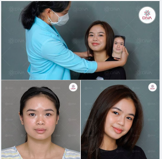 MŨI CAO TỰ NHIÊN, THU HÚT SAU 15 PHÚT NÂNG MŨI TINY POINT