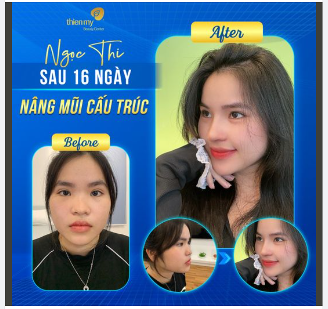 “Trái ngọt” của chị khách sau khi NÂNG MŨI CẤU TRÚC xinh đẹp, thần thái, đẹp trọn đời!