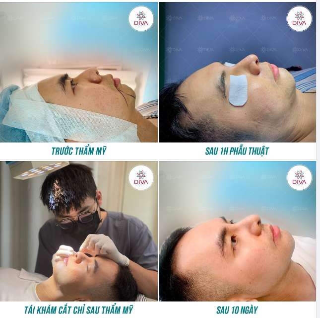 NÂNG MŨI VÀ CẮT CÁNH MŨI ANH KHÁCH CỦA DIVA ĐÃ THAY ĐỔI RA SAO?