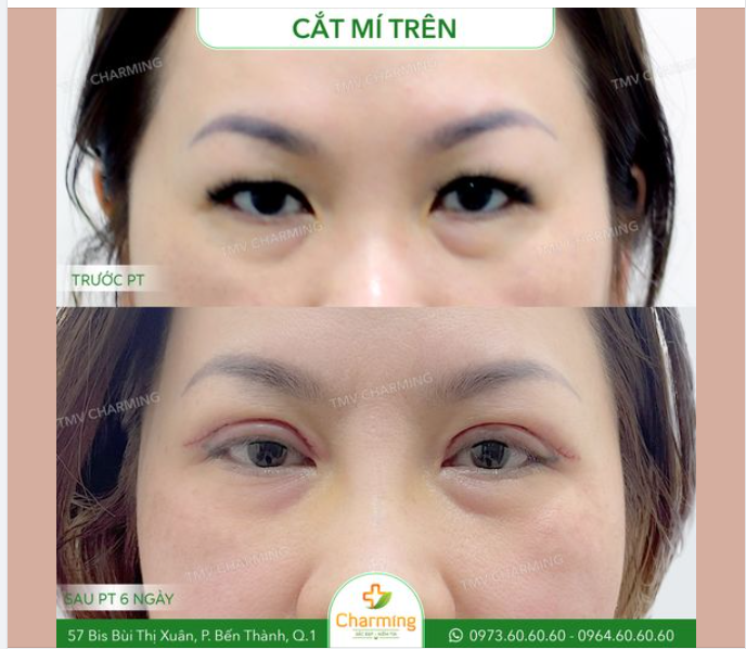 Nàng khách của Charming đã không còn phải cố trang điểm đậm vùng mắt để trông mắt to hơn nữa sau khi cắt mí trên tại Charming.