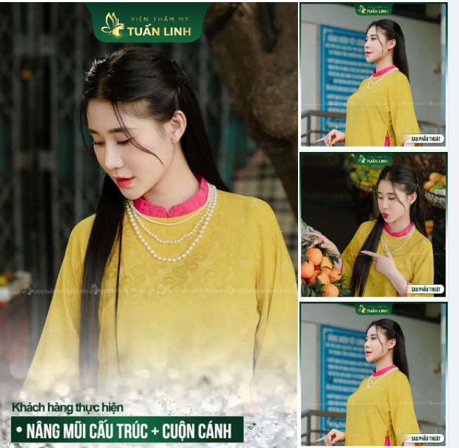 BẬT MÍ ĐỊA CHỈ NÂNG MŨI CẤU TRÚC UY TÍN CHỈ 29TR500