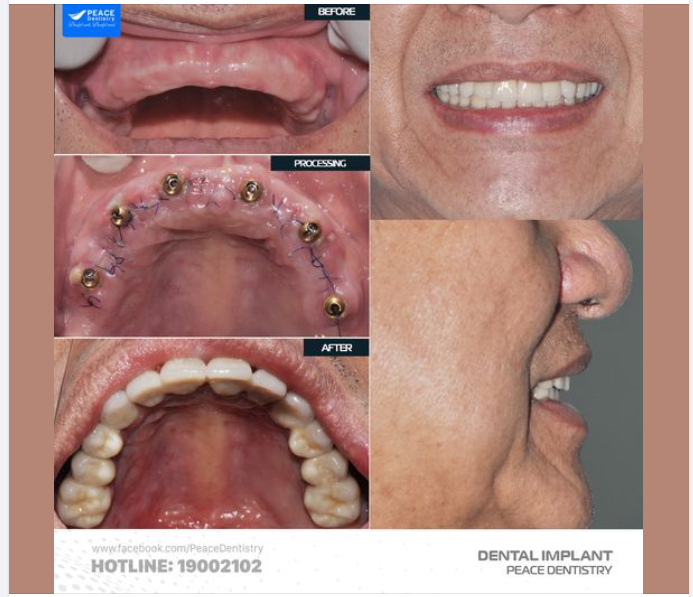 HOÀN THÀNH NHANH  CÓ RĂNG ĂN NHAI CHỈ SAU VÀI NGÀY: một trong những ưu điểm tuyệt vời của ALL-ON-X IMPLANT