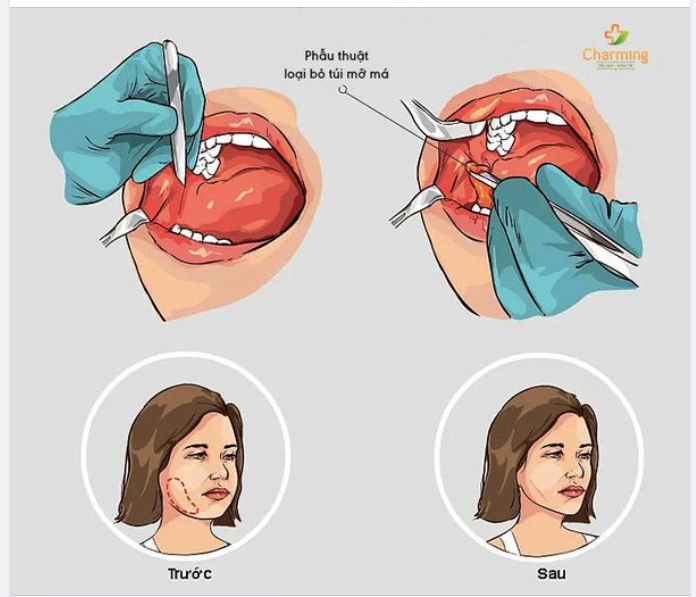 QUY TRÌNH LẤY TÚI MỠ MÁ NHƯ THẾ NÀO?