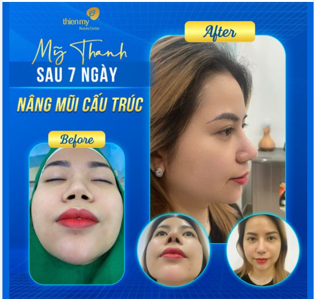 "Nhất sợ đau, nhì sợ không hợp” là những nỗi lo chung của những người đi nâng mũi.