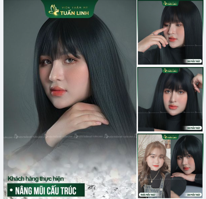 Tự tin và thần thái hơn hẳn. Nhanh tay xin vía “lột xác” hoàn toàn sau nâng mũi của bạn Y.H khách hàng nhà Tuấn Linh nào!!