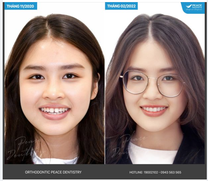 Dưới đây là một số gợi ý cực kỳ hữu ích từ Peace Dentistry cho bạn trong việc chọn nha khoa và chọn bác sĩ để niềng răng.