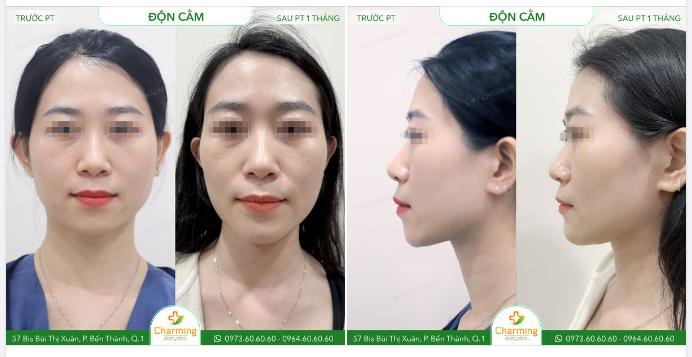 Đôi khi có những trường hợp nhìn có vẻ như bị hô nhưng thật ra vấn đề lại nằm ở chiếc cằm thiếu độ nhô.