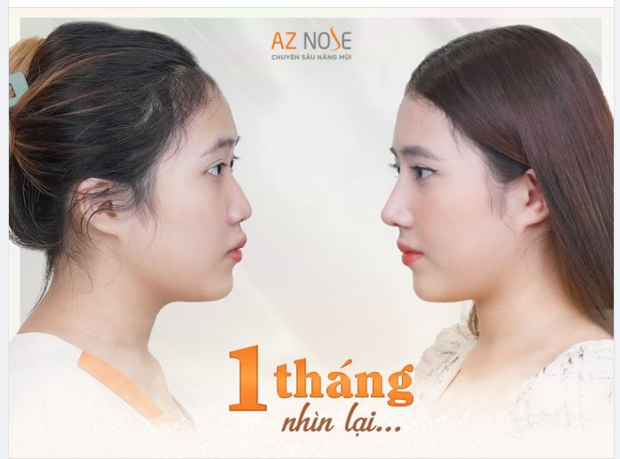 Đừng để chiếc mũi "thấp gồ" khiến bạn tự ti nữa!