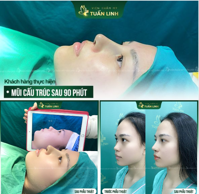 Thay đổi diện mạo chỉ sau 90 phút nâng mũi cấu trúc!!