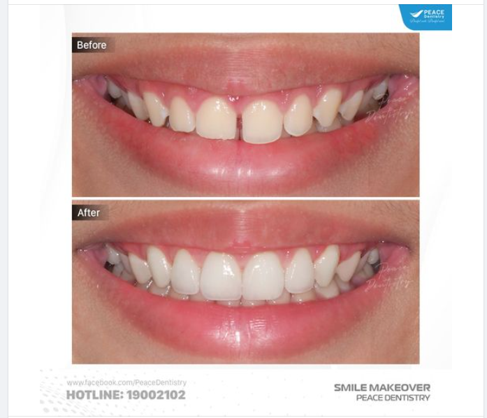 VENEER SỨ ĐÓNG KÍN KHE THƯA | TÁI KHÁM SAU 1 NĂM