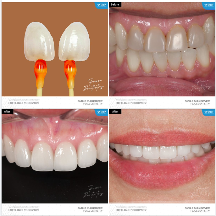 VẬT LIỆU SỨ TỐT  KỸ THUẬT CHẾ TÁC TINH XẢO LÀ YẾU TỐ KHÔNG THỂ THIẾU CHO MỘT CA RĂNG SỨ THÀNH CÔNG