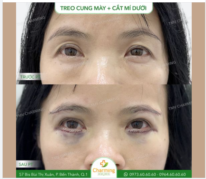 Treo cung mày và cắt mí dưới là một combo rất hợp lý khi thực hiện cùng nhau và nàng khách của Charming đã chọn combo này để nâng cấp vùng mắt.