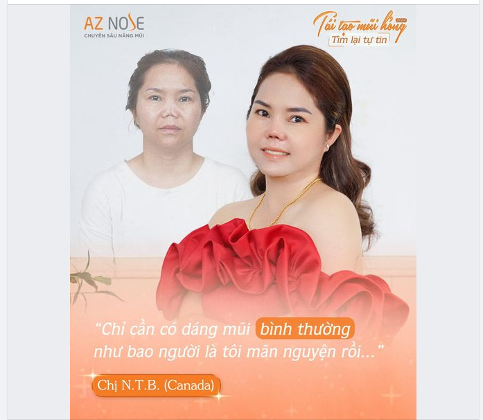 Sau 4 lần nâng mũi bị h.ỏng và 3 năm sống trong m.ặc c.ảm tại Canada, chị N.T.B. đã biết đến và đặt niềm tin vào AZ NOSE.