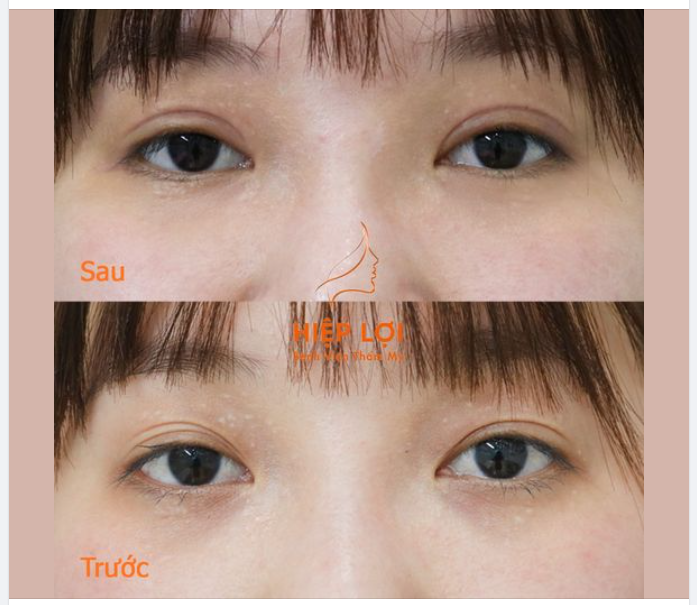 Hình ảnh trước/sau thực hiện cắt mí cho khách hàng - Chỉ 45 phút