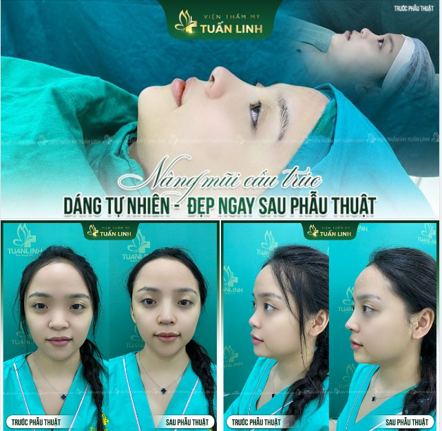 Nâng mũi cấu trúc  Khắc phục khuyết điểm - Mũi cao tự nhiên, phù hợp tỉ lệ gương mặt.