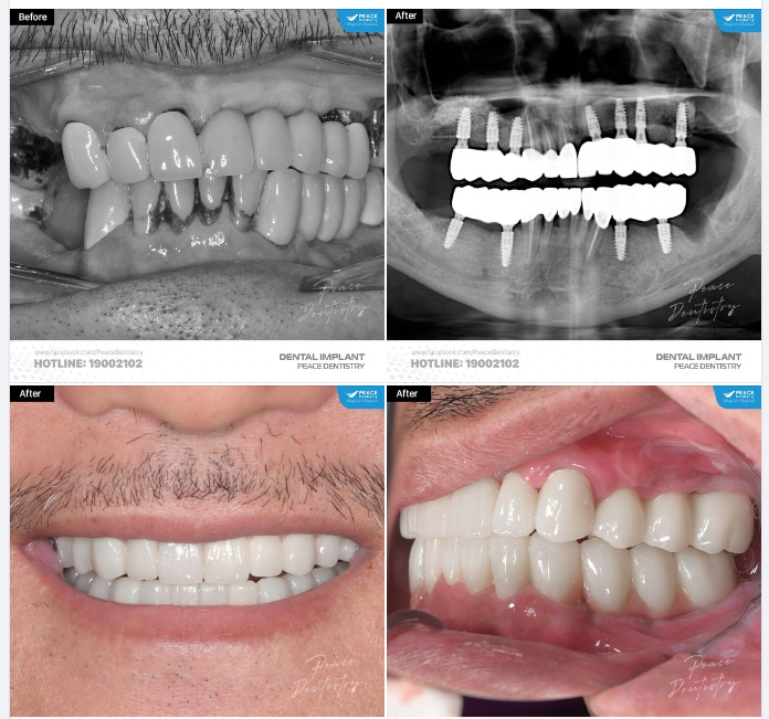 "LIỆU TÔI CÓ ĐỦ SỨC KHỎE ĐỂ CẤY NHIỀU TRỤ IMPLANT CÙNG LÚC?"