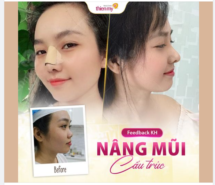 Chỉ cần sửa nhẹ cái mũi là nhan sắc thăng hạng vụt vụt, thật sự vậy sao?