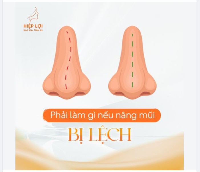 Nếu mũi bạn đang gặp phải tình trạng "lệch sóng", hãy liên hệ ngay đội ngũ tư vấn hoặc bác sĩ để được hỗ trợ cũng như giải đáp thắc mắc.