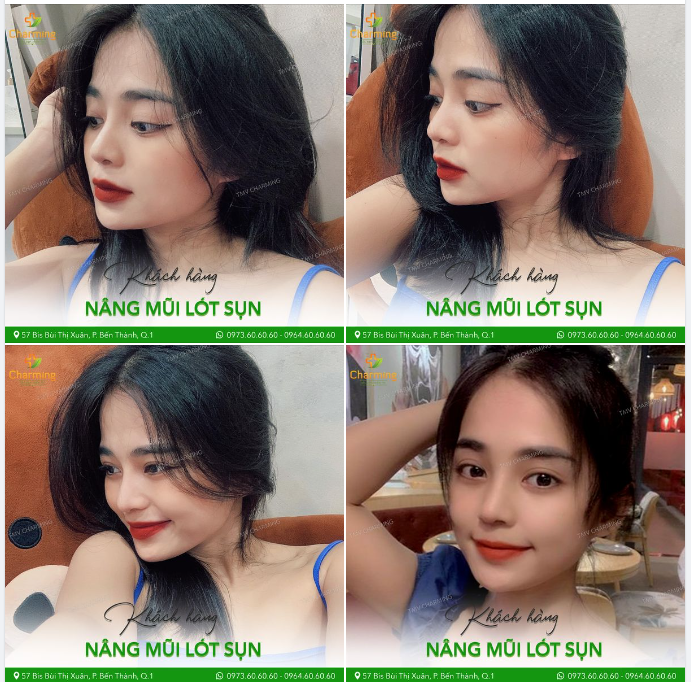 Không biết mọi người thì sao chứ Charming mê ngắm hình góc nghiêng của các nàng khách thực hiện nâng mũi lắm, mà nhìn chiếc mũi lót sụn của nàng khách đây thì Charming đã mê lại càng mê