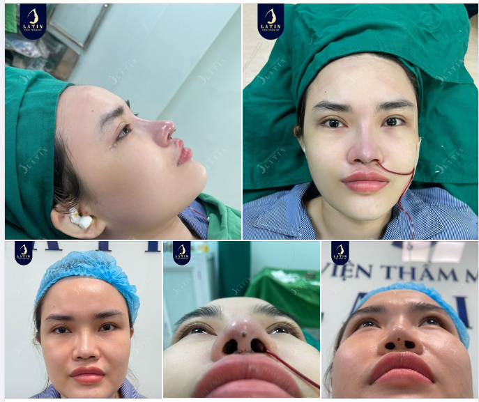 Dáng mũi mới hài hòa và phù hợp với khuôn mặt hơn cho em gái
