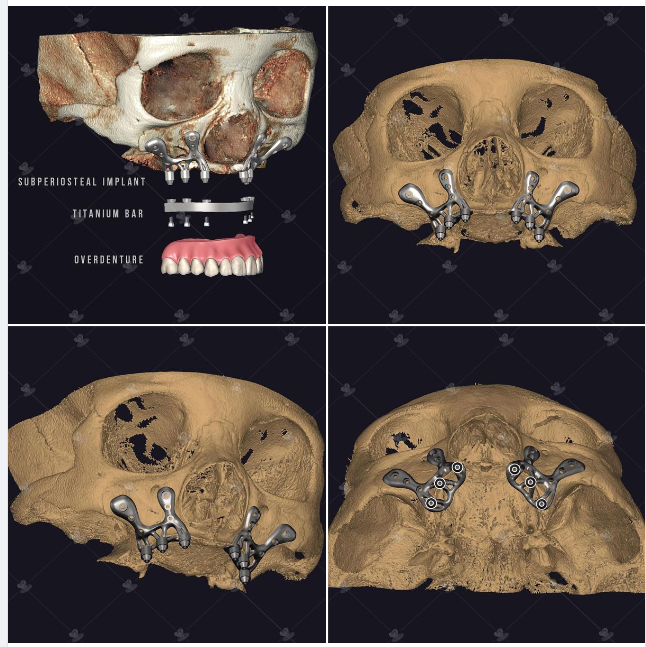 Implant cá nhân hóa . Implan dưới màng xương phù hợp những trường hợp phức tạp như sau: